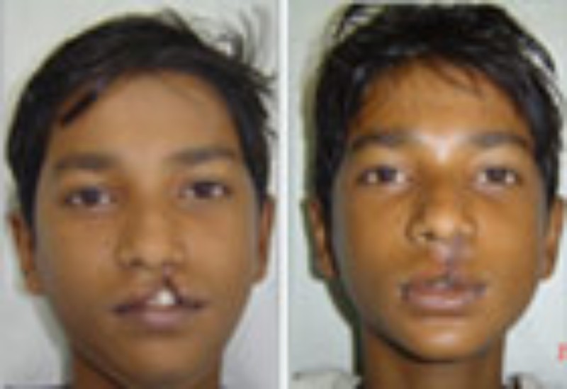 smiletrain